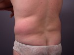 Liposuction Before and after photo