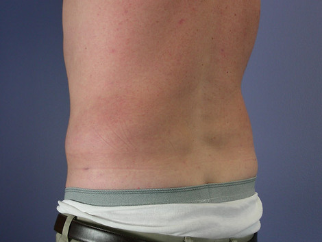 Liposuction before and after photo