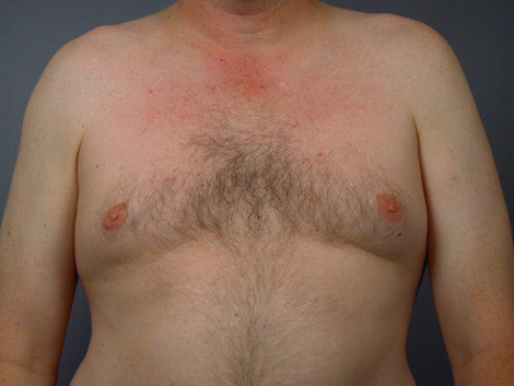 Liposuction before and after photo
