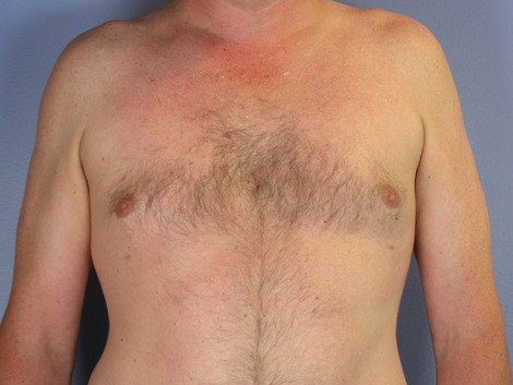 Liposuction before and after photo