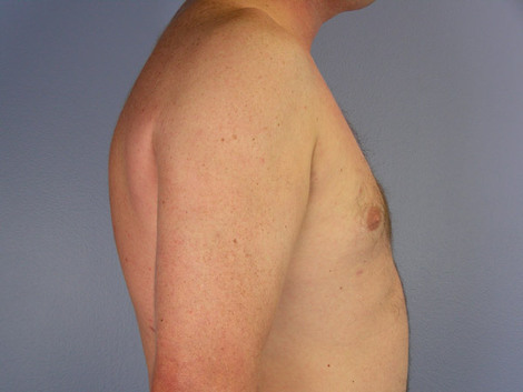 Liposuction before and after photo