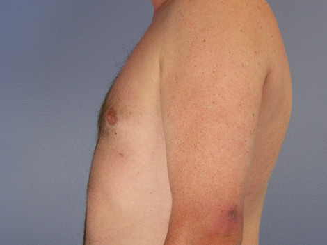 Liposuction before and after photo