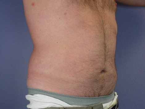 Liposuction before and after photo