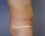 Liposuction Before and after photo