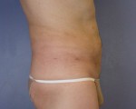 Liposuction Before and after photo