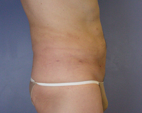 Liposuction before and after photo