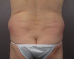 Liposuction Before and after photo