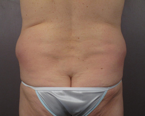 Liposuction before and after photo