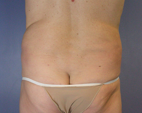 Liposuction before and after photo