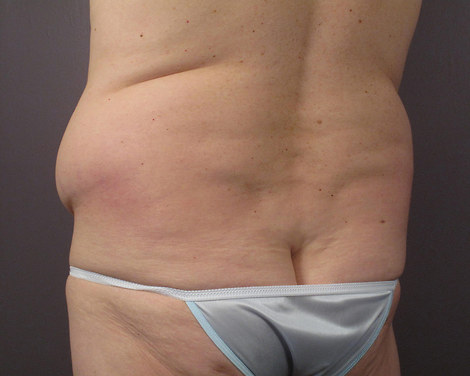 Liposuction before and after photo