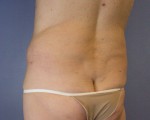 Liposuction Before and after photo