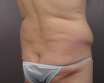 Liposuction Before and after photo