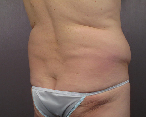 Liposuction before and after photo