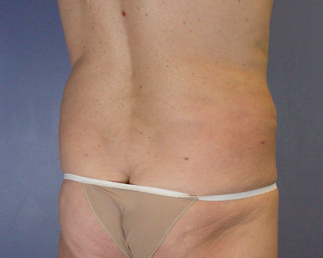 Liposuction before and after photo