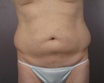 Liposuction Before and after photo