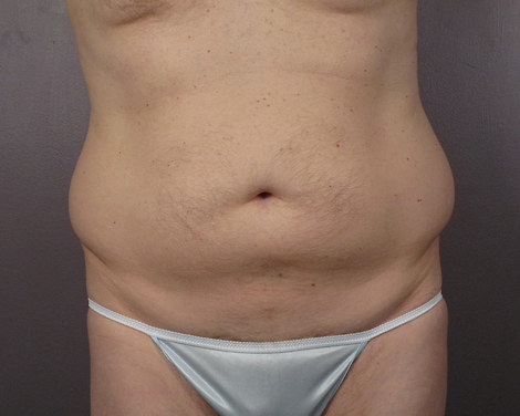 Liposuction before and after photo