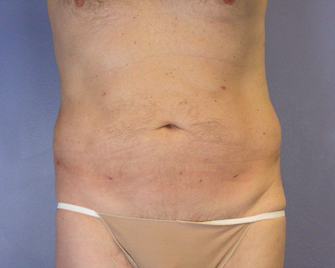 Liposuction before and after photo