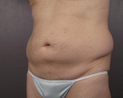 Liposuction before and after photo