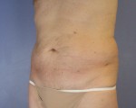 Liposuction Before and after photo