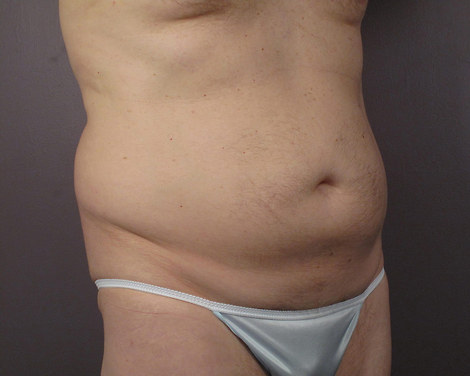 Liposuction before and after photo