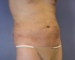 Liposuction Before and after photo