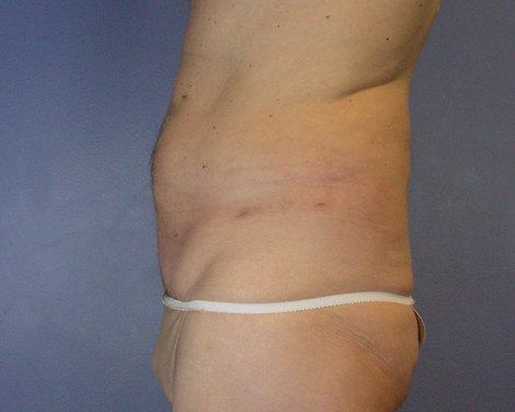 Liposuction before and after photo