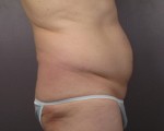 Liposuction Before and after photo