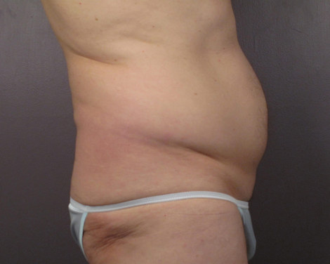 Liposuction before and after photo