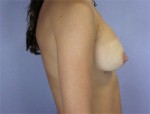 Liposuction Before and after photo