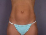 Liposuction Before and after photo