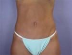 Liposuction Before and after photo