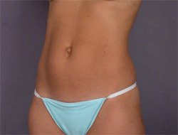 Liposuction before and after photo