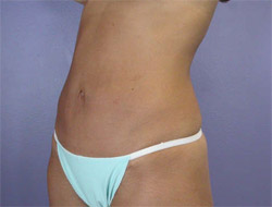 Liposuction before and after photo