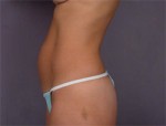 Liposuction Before and after photo