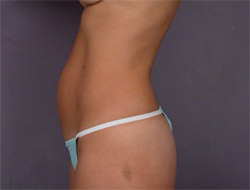 Liposuction before and after photo