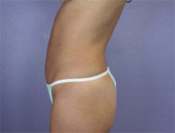 Liposuction before and after photo