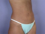 Liposuction Before and after photo