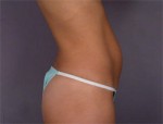 Liposuction Before and after photo