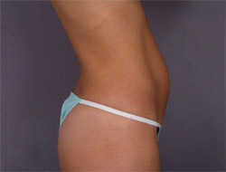 Liposuction before and after photo