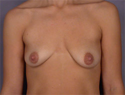 Liposuction before and after photo