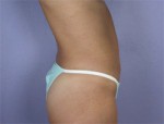 Liposuction Before and after photo