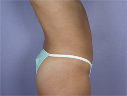 Liposuction before and after photo