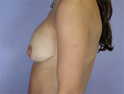 Liposuction before and after photo