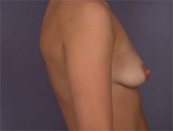 Liposuction before and after photo