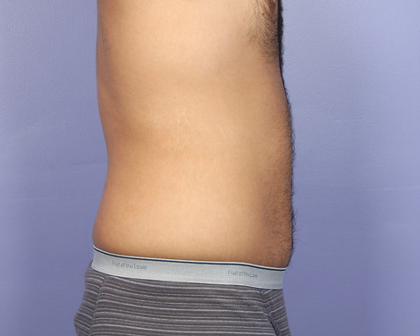 Liposuction before and after photo