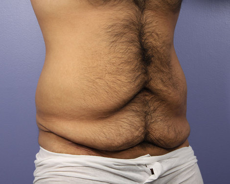 Liposuction before and after photo