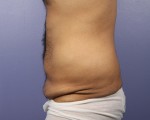 Liposuction Before and after photo
