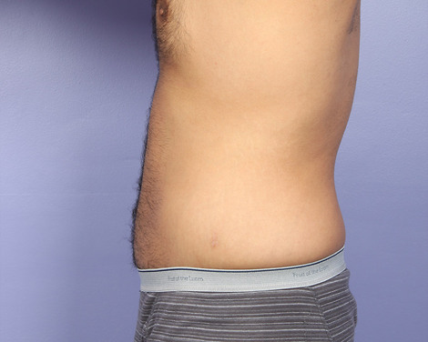 Liposuction before and after photo