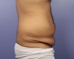 Liposuction Before and after photo