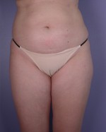Liposuction